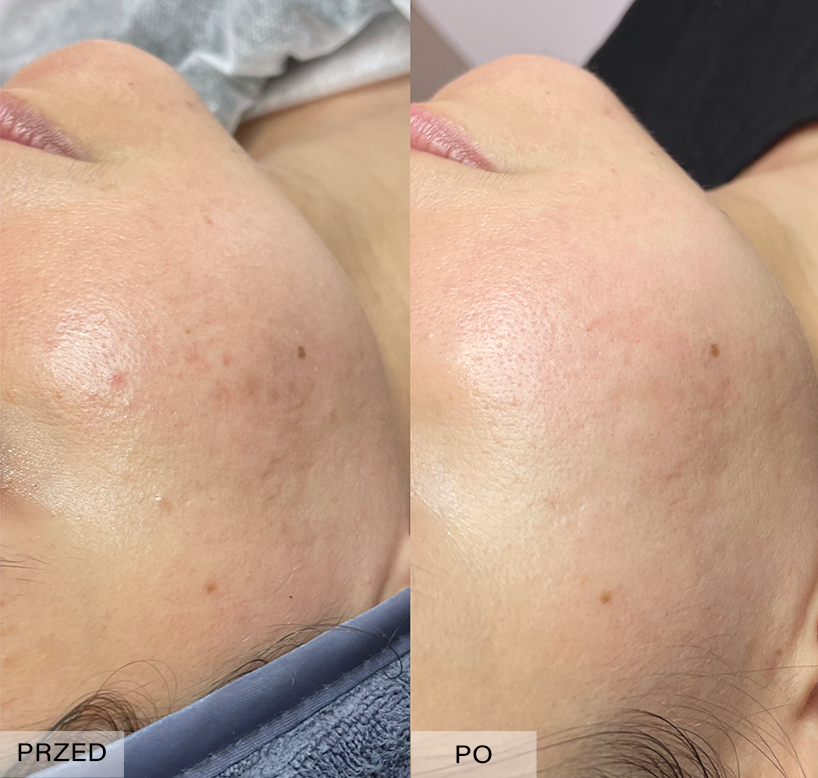 usuwanie blizn efekty